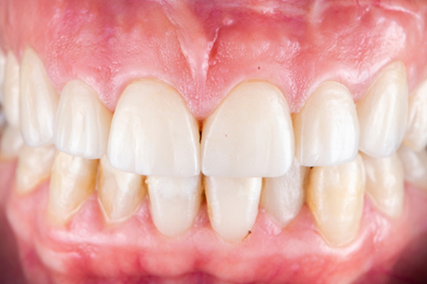 Why Choose Implant Supported Dentures?